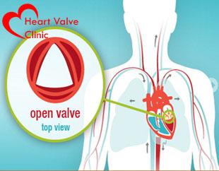 Heart valve